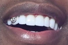 Picture of Lil Durk teeth and smile
