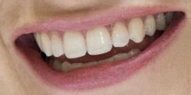 Picture of Lily James teeth and smile