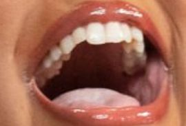 Lizzo's teeth