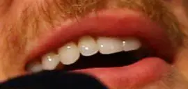 Picture of Logan Paul teeth and smile