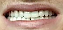 Picture of Logan Paul teeth and smile