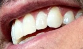 Image of Luke Bryan teeth