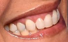 Picture of Marlee Matlin teeth and smile