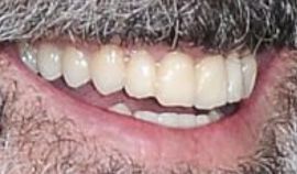 Picture of Mel Gibson healthy teeth and smile