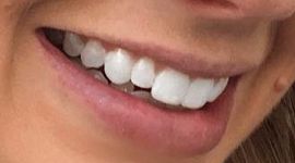 Picture of Melissa Ordway teeth and smile