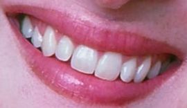 Meryl Streep teeth