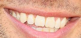Picture of Michael Ray teeth and smile