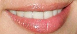 Picture of Nicky Hilton Rothschild teeth and smile
