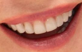 Picture of Nicole Kidman teeth and smile