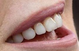 Picture of Nicole Kidman teeth and smile