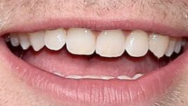 Picture of Robert Pattinson healthy teeth and smile