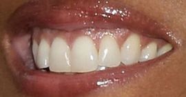 Picture of Robin Roberts teeth and smile