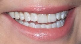Image of Sandra Bullock teeth