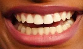 Picture of Saniyya Sidney teeth and smile