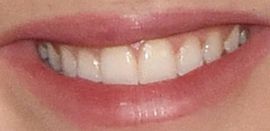 Picture of Talitha Bateman teeth and smile