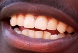 Picture of Tyreek Hill teeth and smile