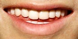 Picture of Zayn Malik teeth and smile