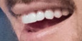 Picture of Adam Lambert teeth and smile