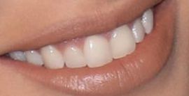Picture of Adriana Lima's teeth