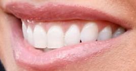 Picture of Alexa Bliss teeth and smile