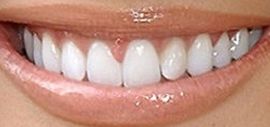Picture of Ali Landry teeth and smile