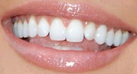Picture of Ali Landry teeth and smile