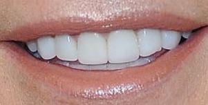 Picture of Allison Dunbar teeth and smile