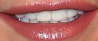 Picture of Allison Dunbar teeth and smile