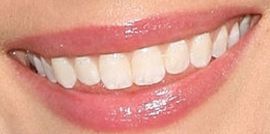 Picture of Allison Miller teeth and smile