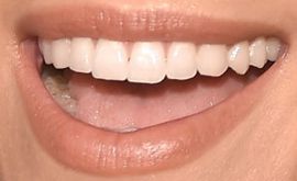 Picture of Allison Williams teeth and smile