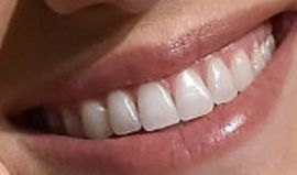 Picture of Allison Williams teeth and smile