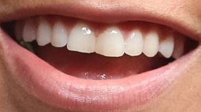 Picture of Amanda Nunes teeth and smile