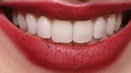 Picture of Amber Heard teeth and smile