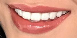 Picture of Andrea Meza teeth and smile
