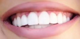 Picture of Anna Zak teeth and smile