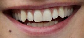 Picture of Ansel Elgort teeth and smile