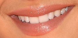 Picture of Ariana Grande's teeth and smile while smiling