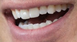 Picture of Arie Luyendyk Jr. teeth and smile