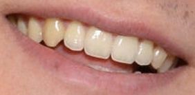 Picture of Asa Butterfield's teeth while smiling