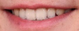 Picture of Asa Butterfield's teeth while smiling