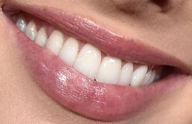 Picture of Ashleigh Brewer teeth and smile