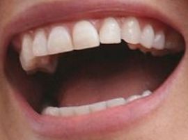 Picture of Bar Refaeli teeth and smile