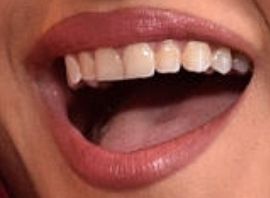 Picture of Bebe Rexha teeth and smile
