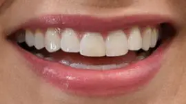 Picture of Becca Kufrin teeth and smile