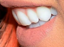 Picture of Becky Lynch's teeth and smile while smiling
