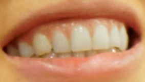 Picture of Becky Lynch's teeth and smile while smiling