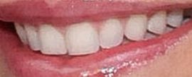 Picture of Bethenny Frankel teeth and smile
