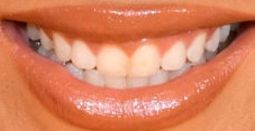 Picture of Beyonce's teeth