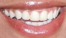 Picture of Beyonce's teeth while smiling