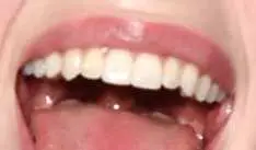 Billie Eilish's teeth and smile